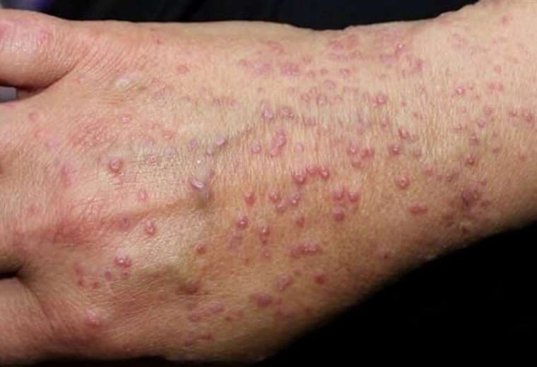 ¿Cuál es la relación entre el estrés y las enfermedades de la piel?