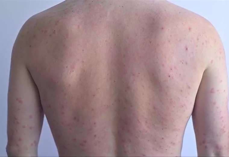 Médicos advierten: un paciente con sarampión puede contagiar hasta 18 personas